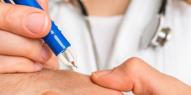 A doctor carefully tweezing a tick off of her patient